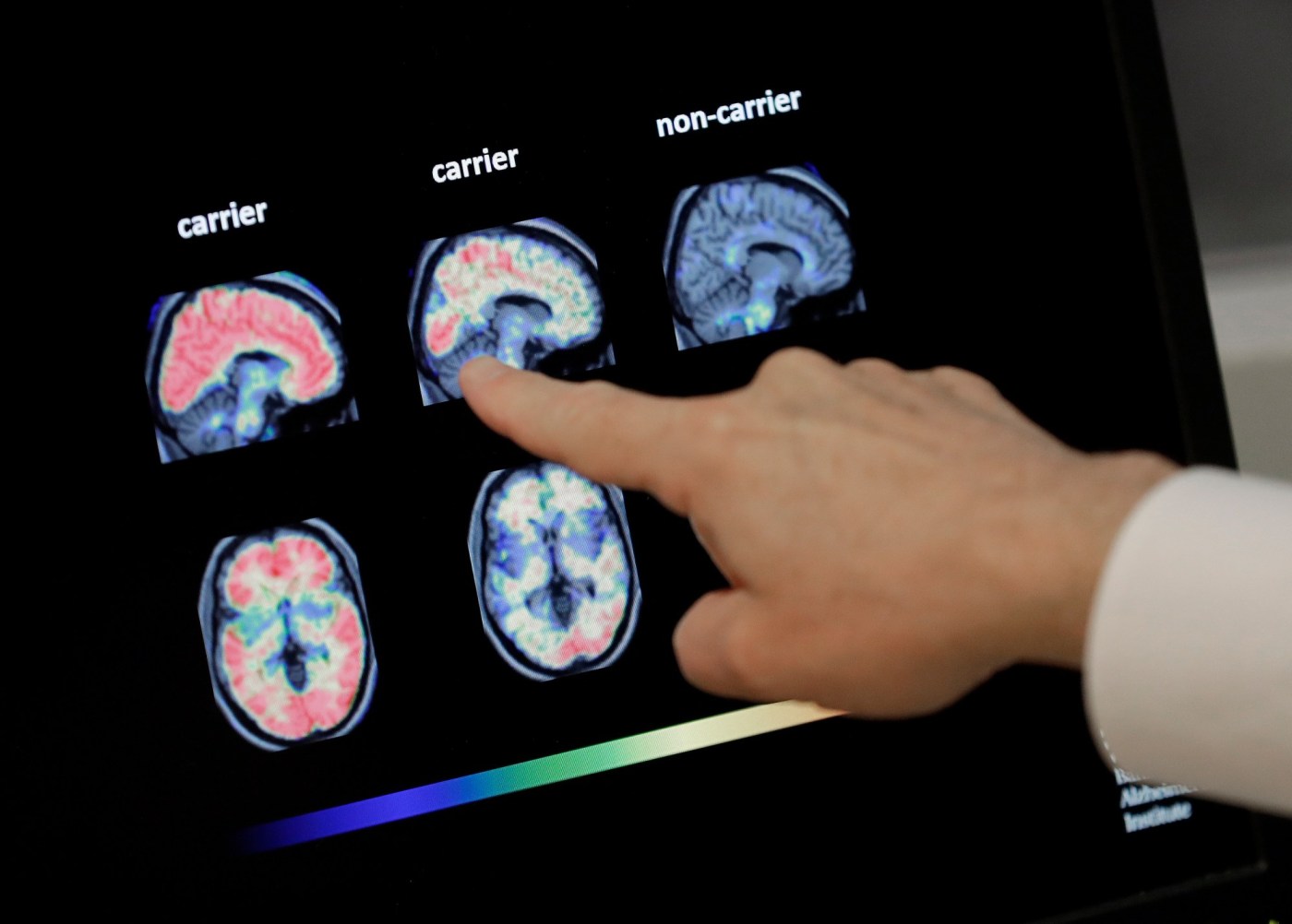 Shingles is awful, but here’s another reason to get vaccinated: It may fight dementia