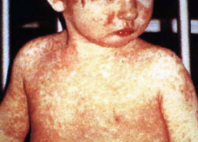 11 US state now facing a measles outbreak. Here’s what to know