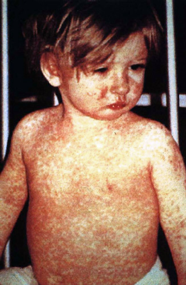 11 US state now facing a measles outbreak. Here’s what to know