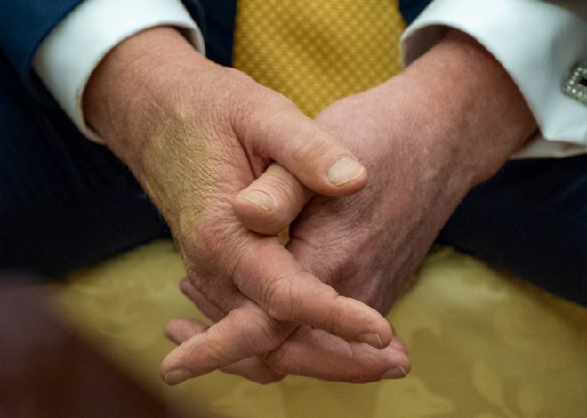 Trump is checked for swelling in legs, diagnosed with common condition in older adults