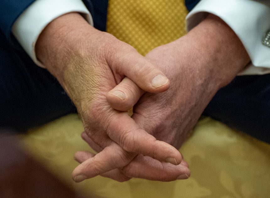 Trump is checked for swelling in legs, diagnosed with common condition in older adults
